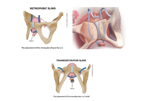 Urethrocele